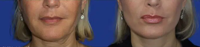 faceology lift neck Lift before and after photo by faceology md in newport beach ca