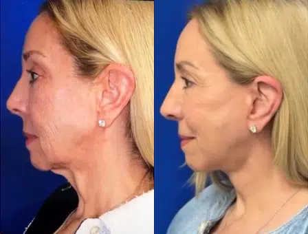 faceology lift neck Lift before and after photo by faceology md in newport beach ca