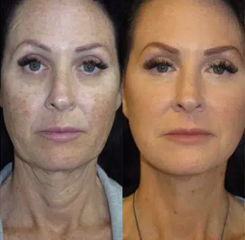 faceology lift neck Lift before and after photo by faceology md in newport beach ca