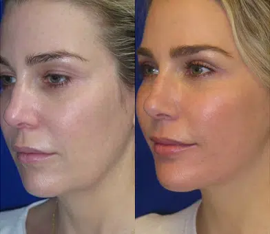 faceology lift neck Lift before and after photo by faceology md in newport beach ca
