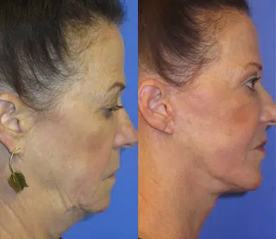 faceology lift neck Lift before and after photo by faceology md in newport beach ca