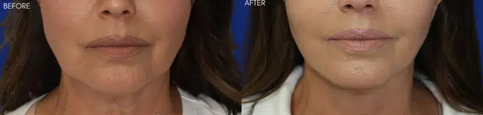 faceology lift neck Lift before and after photo by faceology md in newport beach ca