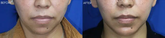 faceology lift neck Lift before and after photo by faceology md in newport beach ca