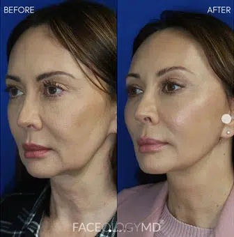 faceology lift neck Lift before and after photo by faceology md in newport beach ca
