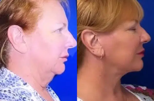 faceology lift neck Lift before and after photo by faceology md in newport beach ca