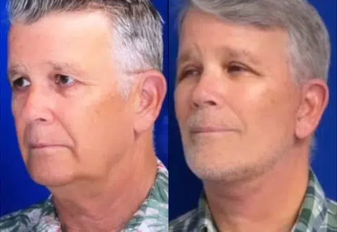faceology lift neck Lift before and after photo by faceology md in newport beach ca