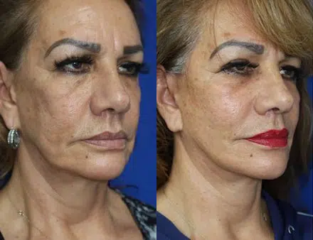 faceology lift neck Lift before and after photo by faceology md in newport beach ca