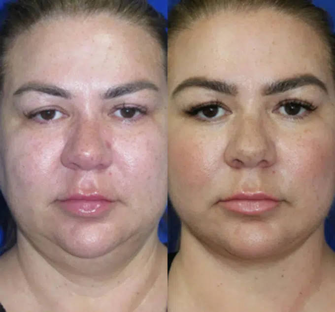 faceology lift neck Lift before and after photo by faceology md in newport beach ca