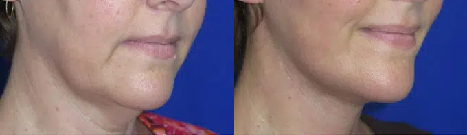 faceology lift neck Lift before and after photo by faceology md in newport beach ca
