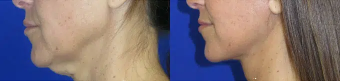 faceology lift neck Lift before and after photo by faceology md in newport beach ca