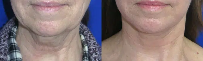faceology lift neck Lift before and after photo by faceology md in newport beach ca