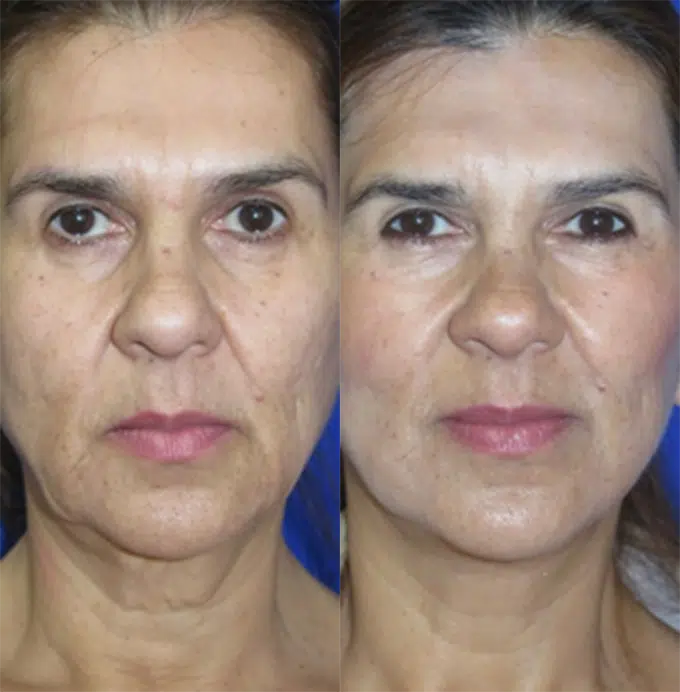 faceology lift neck Lift before and after photo by faceology md in newport beach ca