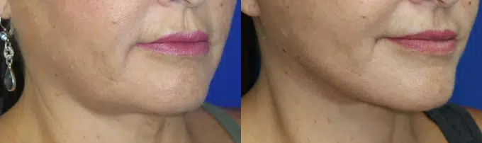 faceology lift neck Lift before and after photo by faceology md in newport beach ca