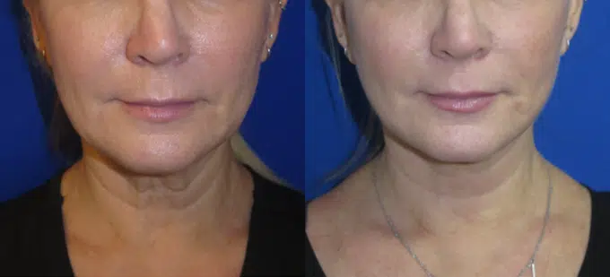 faceology lift neck Lift before and after photo by faceology md in newport beach ca