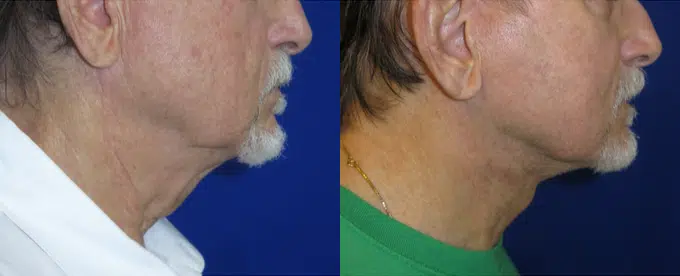 faceology lift neck Lift before and after photo by faceology md in newport beach ca