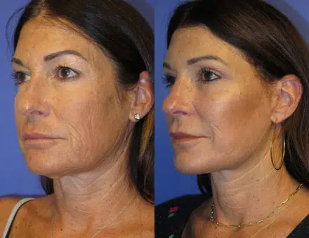 faceology lift neck Lift before and after photo by faceology md in newport beach ca