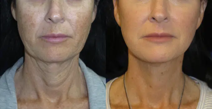 faceology lift neck Lift before and after photo by faceology md in newport beach ca