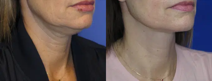 faceology lift neck Lift before and after photo by faceology md in newport beach ca