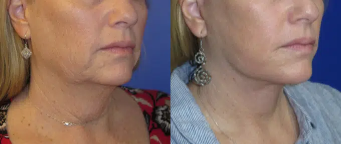 faceology lift neck Lift before and after photo by faceology md in newport beach ca