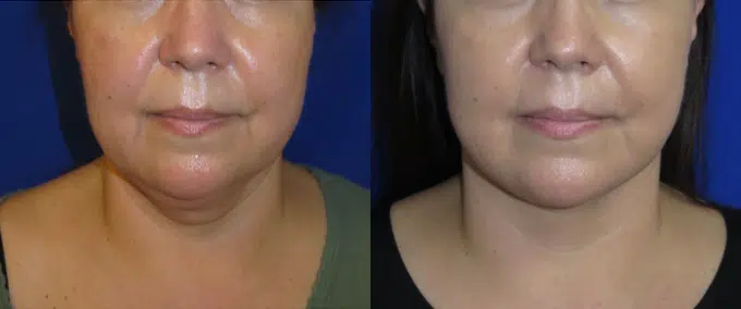 faceology lift neck Lift before and after photo by faceology md in newport beach ca