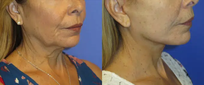 faceology lift neck Lift before and after photo by faceology md in newport beach ca