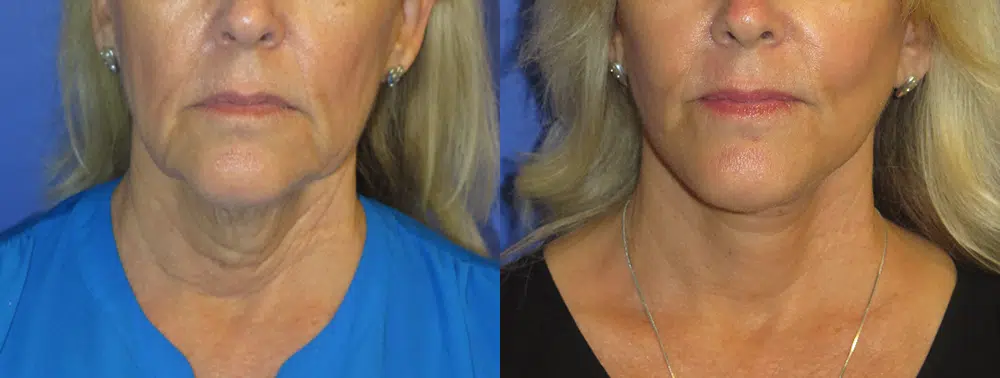 faceology lift neck Lift before and after photo by faceology md in newport beach ca