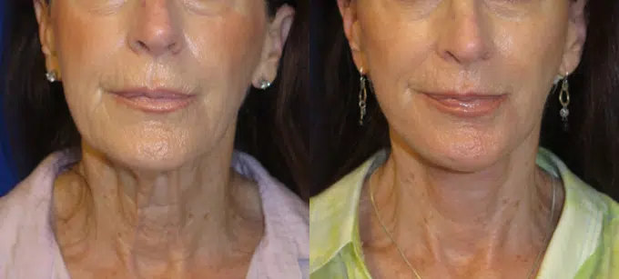 faceology lift neck Lift before and after photo by faceology md in newport beach ca