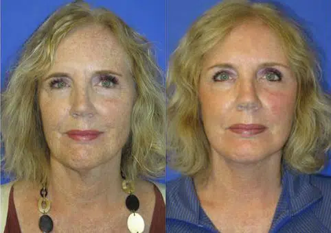 faceology lift neck Lift before and after photo by faceology md in newport beach ca