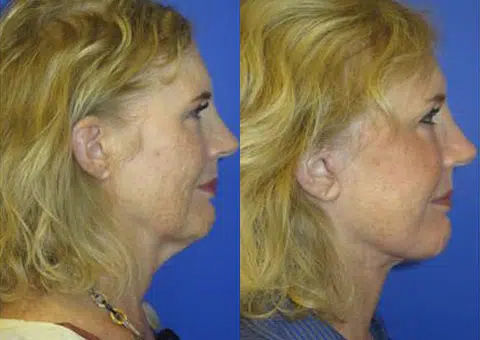 faceology lift neck Lift before and after photo by faceology md in newport beach ca faceology lift neck Lift before and after photo by faceology md in newport beach ca