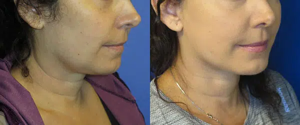faceology lift neck Lift before and after photo by faceology md in newport beach ca