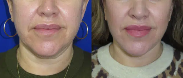 faceology lift neck Lift before and after photo by faceology md in newport beach ca