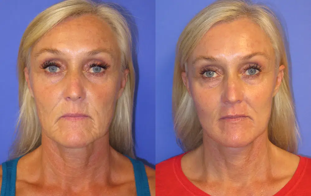 faceology lift neck Lift before and after photo by faceology md in newport beach ca