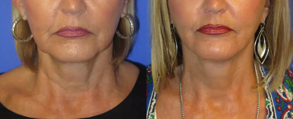 faceology lift neck Lift before and after photo by faceology md in newport beach ca