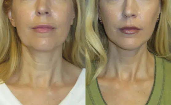 faceology lift neck Lift before and after photo by faceology md in newport beach ca