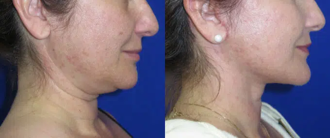 faceology lift neck Lift before and after photo by faceology md in newport beach ca