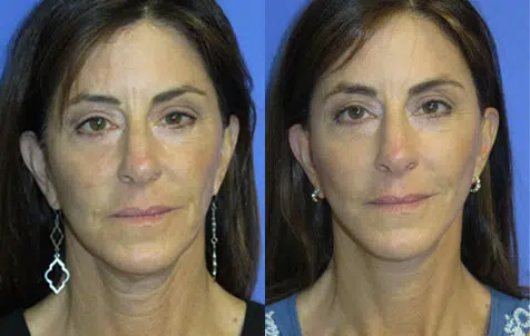 faceology lift neck Lift before and after photo by faceology md in newport beach ca