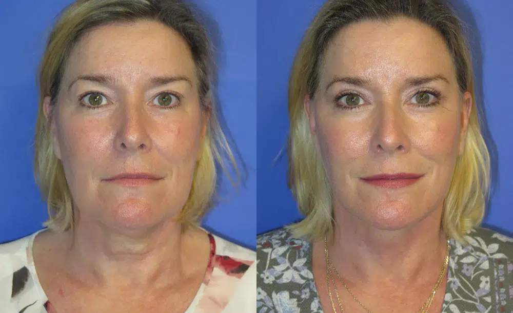 faceology lift neck Lift before and after photo by faceology md in newport beach ca