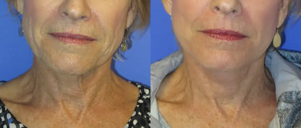 faceology lift neck Lift before and after photo by faceology md in newport beach ca