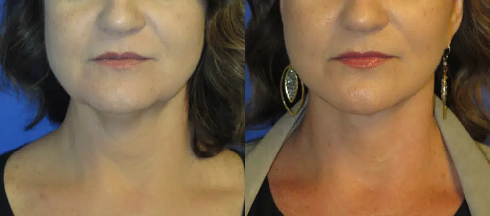faceology lift neck Lift before and after photo by faceology md in newport beach ca