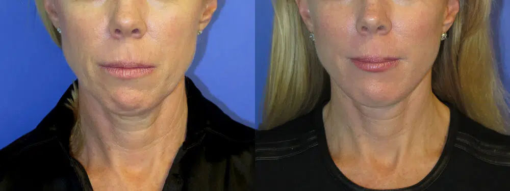 faceology lift neck Lift before and after photo by faceology md in newport beach ca