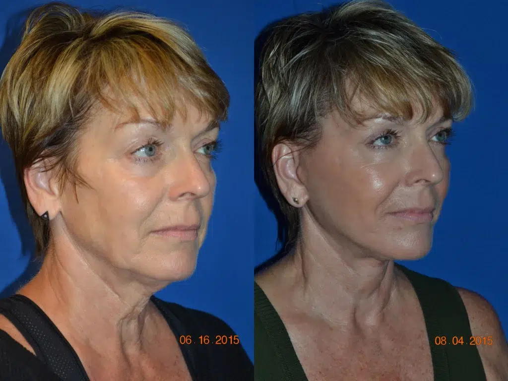 faceology lift neck Lift before and after photo by faceology md in newport beach ca