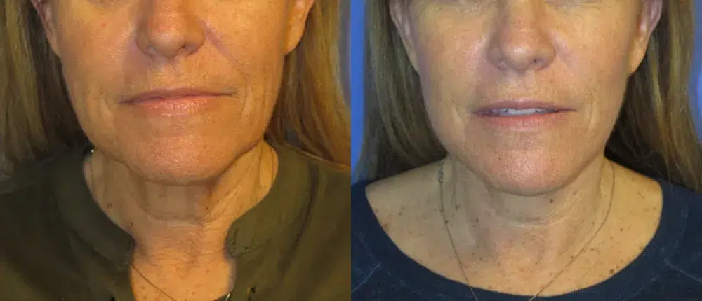 faceology lift neck Lift before and after photo by faceology md in newport beach ca