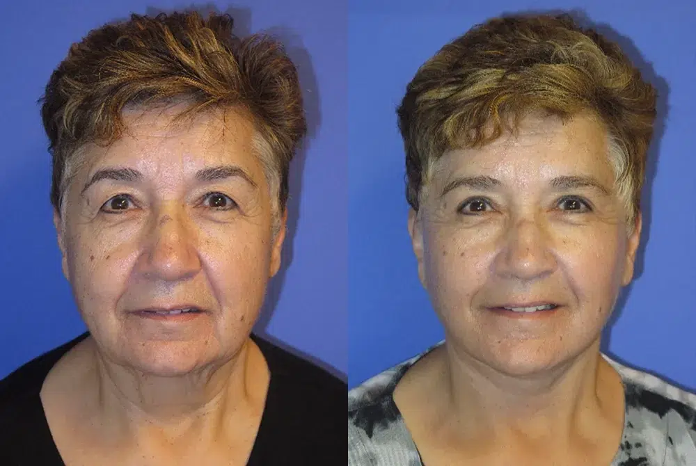 faceology lift neck Lift before and after photo by faceology md in newport beach ca