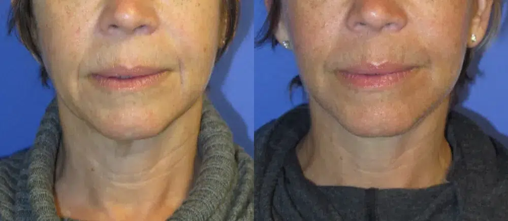 faceology lift neck Lift before and after photo by faceology md in newport beach ca