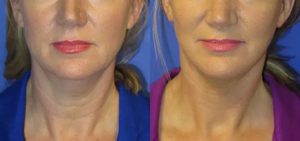 faceology lift neck Lift before and after photo by faceology md in newport beach ca