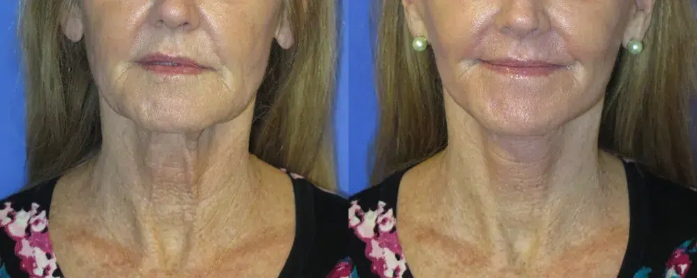faceology lift neck Lift before and after photo by faceology md in newport beach ca