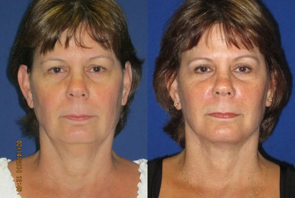 faceology lift neck Lift before and after photo by faceology md in newport beach ca