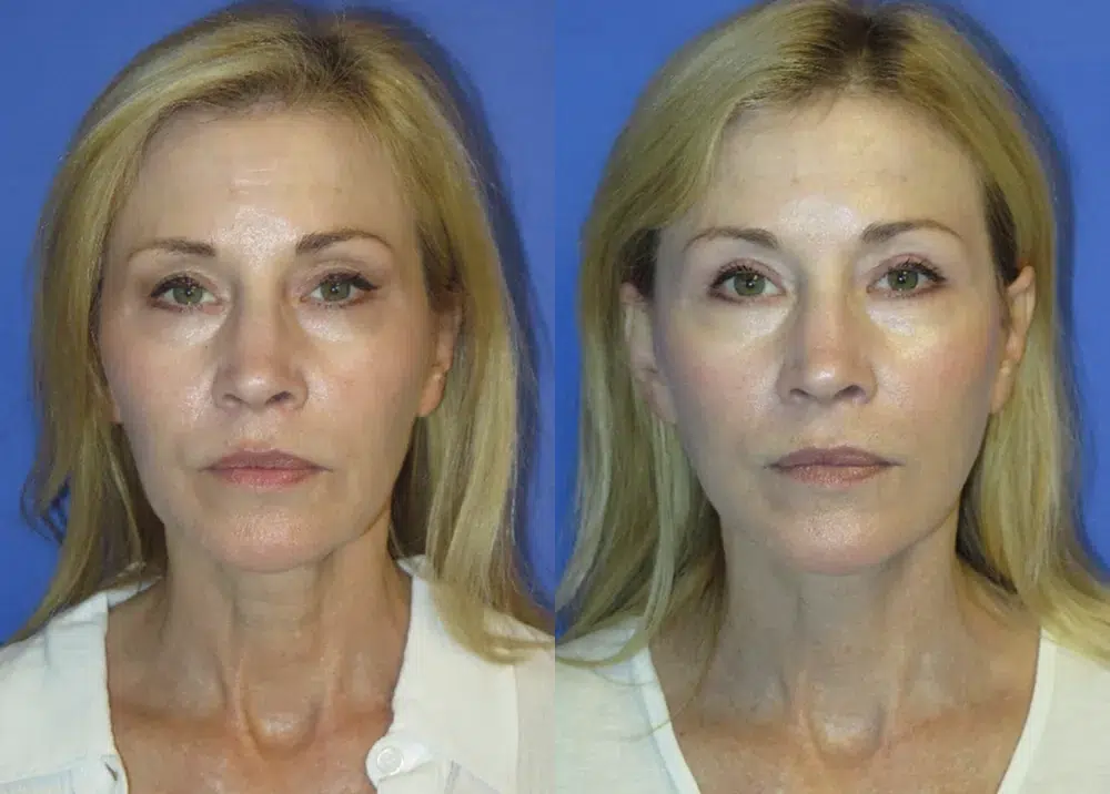 faceology lift neck Lift before and after photo by faceology md in newport beach ca