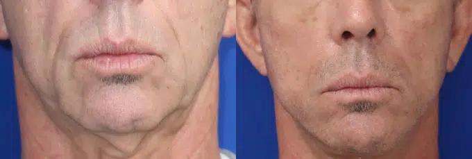 faceology lift neck Lift before and after photo by faceology md in newport beach ca