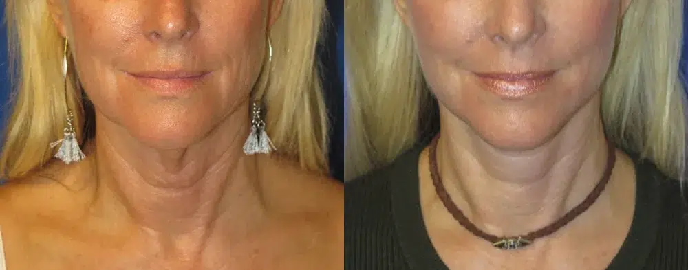 faceology lift neck Lift before and after photo by faceology md in newport beach ca